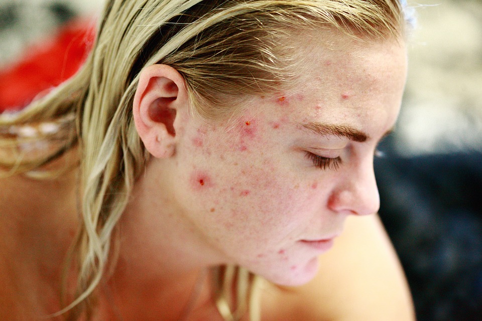 How you Can get rid of Acne using a Sauna and its Detoxification Processes